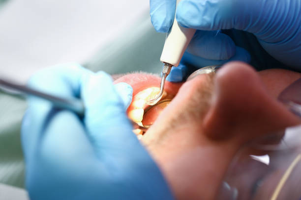 Best Emergency Wisdom Teeth Removal in Warsaw, NC