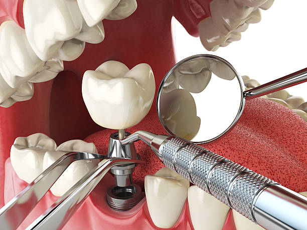 Best Emergency Treatment for Dental Infections or Abscesses in Warsaw, NC